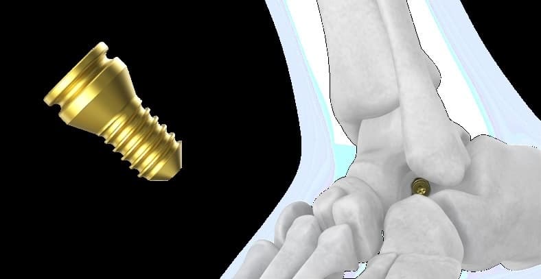 Subtalar Joint Stabilization Screw(T)